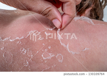 Close-Up of Peeling Sunburned Skin on Shoulder Showing Healing Process and Overexposure to Sunlight 130109764