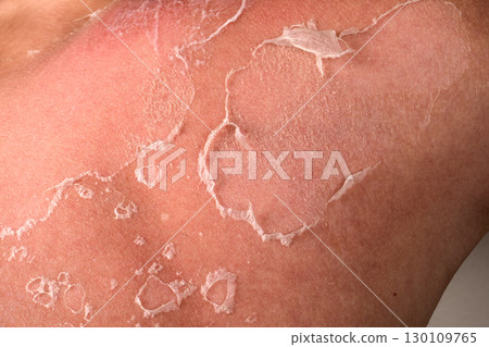 Close-Up of Peeling Sunburned Skin on Shoulder Showing Damage and Natural Healing Process Close-Up of Peeling Sunburned Skin on Shoulder Showing Damage and Natural Healing Process 130109765