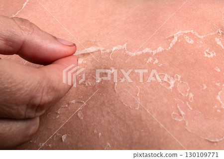 Close-Up of Peeling Skin After Sunburn Showing Dryness, Damage, and Healing Process Close-Up of Peeling Skin After Sunburn Showing Dryness, Damage, and Healing Process 130109771