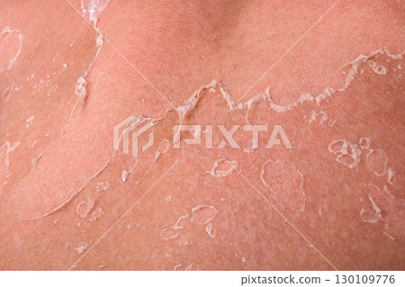 Close-Up of Peeling Skin on Back After Sunburn, Showing Healing Process and Sun Damage Close-Up of Peeling Skin on Back After Sunburn, Showing Healing Process and Sun Damage 130109776