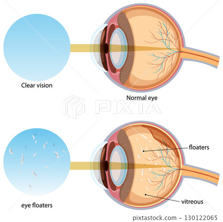 Comparison of Normal Eye and Eye Floaters Illustration 130122065