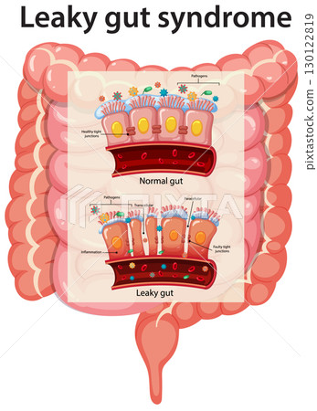 Leaky Gut Syndrome Vector Diagram with Intestinal Comparison 130122819