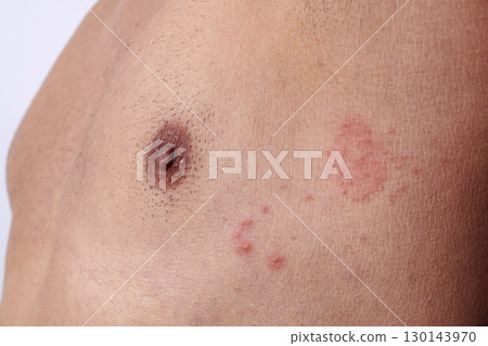 close-up of shingles on the chest of a man 130143970