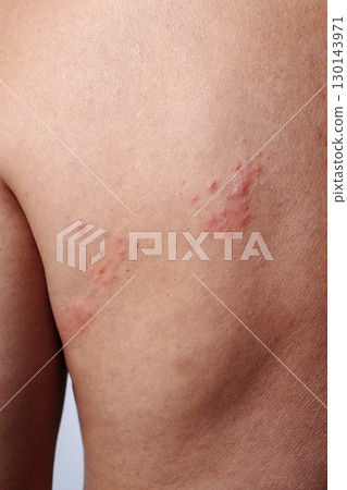 shingles outbreak on the shoulder blade of a man 130143971