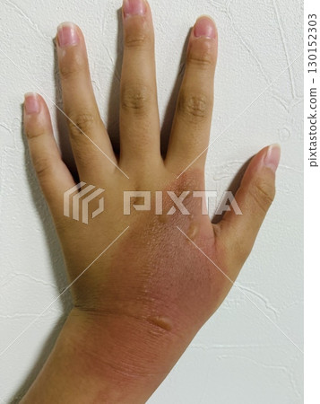 手背早期燒傷 手背早期燒傷 130152303