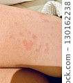 Eczema after swimming 130162238