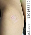 Child's knee abrasion 130162240