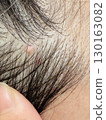 Scalp warts 130163082