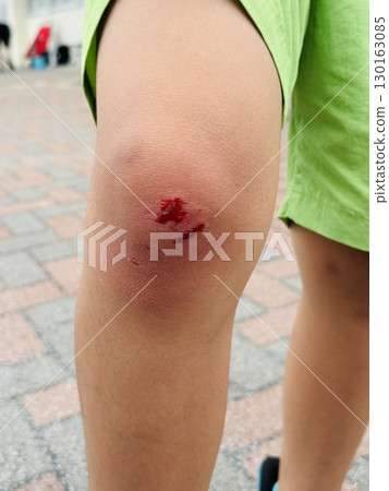The knee of a child who fell 130163085