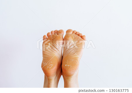 cracked peeling skin on woman's feet cracked peeling skin on woman's feet 130163775
