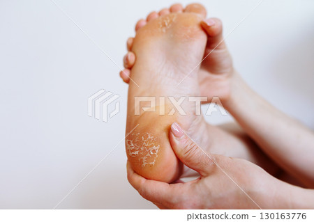 cracked peeling skin on woman's feet 130163776