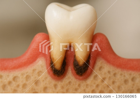 Periodontal disease: Red, swollen gums and gums 130166065