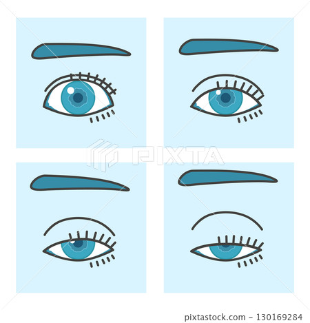 Illustration of ptosis Illustration of ptosis 130169284
