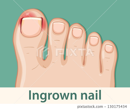 Vector Illustration of Ingrown Toenail on Big Toe 130175434