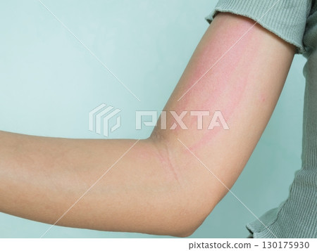 Hand with Urticaria Allergy Itchy Rash Eczema Itch Woman from Food,Air Poisoning,Cosmetic,Health,Body Care Disease Lilness Air,Dissease Medicine Calamine Lotion Treatment ,Infection Pain Sick Scratch. 130175930