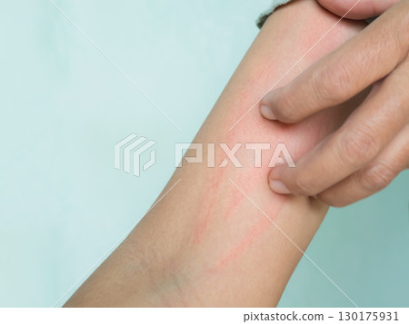 Hand with Urticaria Allergy Itchy Rash Eczema Itch Woman from Food,Air Poisoning,Cosmetic,Health,Body Care Disease Lilness Air,Dissease Medicine Calamine Lotion Treatment ,Infection Pain Sick Scratch. 130175931