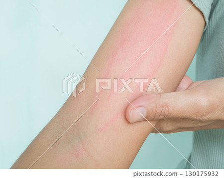 Hand with Urticaria Allergy Itchy Rash Eczema Itch Woman from Food,Air Poisoning,Cosmetic,Health,Body Care Disease Lilness Air,Dissease Medicine Calamine Lotion Treatment ,Infection Pain Sick Scratch. 130175932