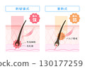 Comparison illustration of laser hair removal, thermal destruction type and heat storage type 130177259