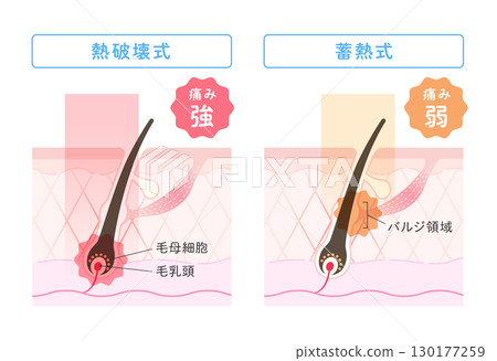 雷射除毛、熱破壞型與儲熱型的比較圖 130177259