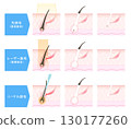 Hair removal treatment methods, beauty salon hair removal, medical laser hair removal, needle hair removal 130177260