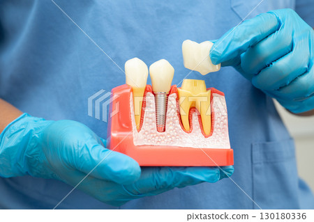 Teeth root dental model with tool for dentist use to cleaning care treatment. Teeth root dental model with tool for dentist use to cleaning care treatment. 130180336
