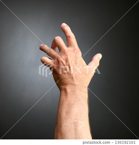 Hand of an man with Dupuytren contracture disease, Hand of an man with Dupuytren contracture disease, 130192101