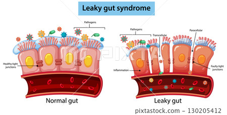 Comparison of Normal Gut and Leaky Gut Syndrome Comparison of Normal Gut and Leaky Gut Syndrome 130205412