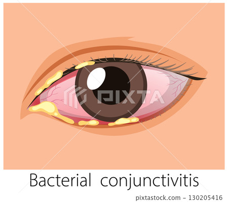 Vector Illustration of Bacterial Conjunctivitis in Human Eye Vector Illustration of Bacterial Conjunctivitis in Human Eye 130205416
