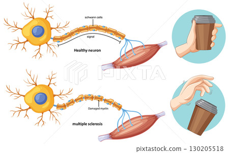 Comparison of Healthy Neuron and Multiple Sclerosis Effects Comparison of Healthy Neuron and Multiple Sclerosis Effects 130205518