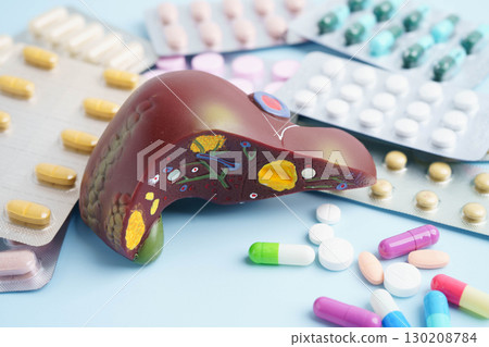 Liver model with pill drug treatment, Cirrhosis, Liver cancer, fatty liver. Liver model with pill drug treatment, Cirrhosis, Liver cancer, fatty liver. 130208784
