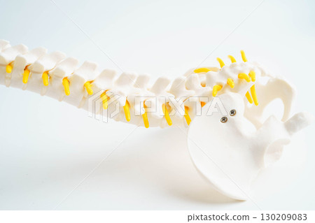 Spinal nerve and bone, Lumbar spine displaced herniated disc fragment, Model for treatment medical in the orthopedic department. 130209083