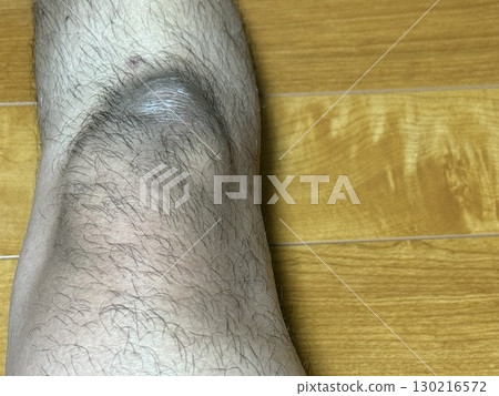 Knee hair removal before men's aesthetic treatment Knee hair removal before men's aesthetic treatment 130216572