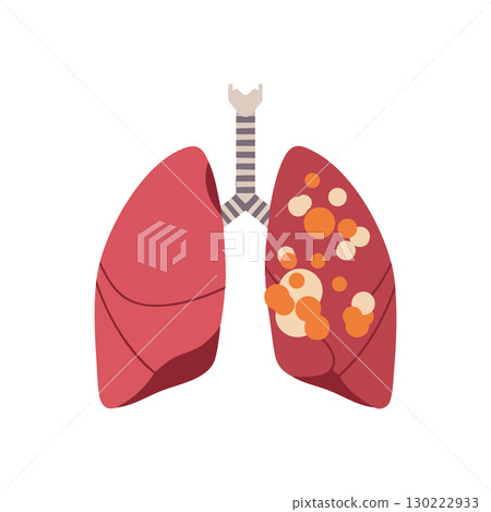 Human lungs illustration with lung disease infection vector medical concept 130222933