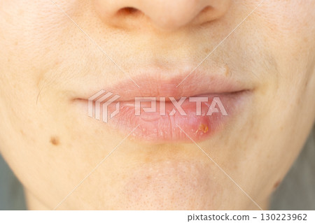 Macro Closeup of Herpes on Human Lip. 130223962