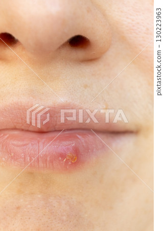 Macro Closeup of Herpes on Human Lip. Macro Closeup of Herpes on Human Lip. 130223963