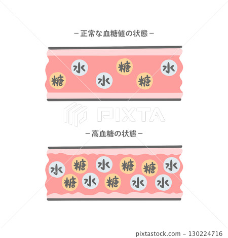 血糖正常的血管與血糖高的血管的對比圖_Pastel 血糖正常的血管與血糖高的血管的對比圖_Pastel 130224716