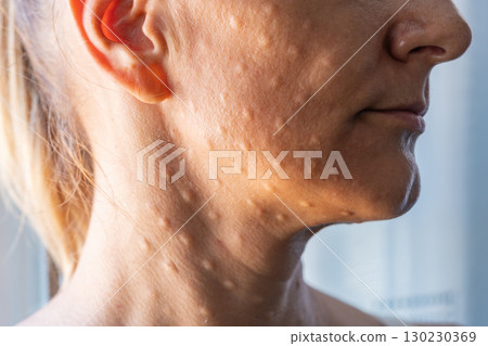 Woman's face after mesotherapy injections biorevitalization. Woman's face after mesotherapy injections biorevitalization. 130230369