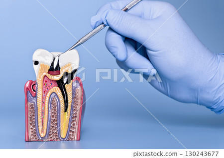 gloved hand using a dental explorer on an anatomical tooth model showing severe decay affecting enamel, dentin, and pulp. gloved hand using a dental explorer on an anatomical tooth model showing severe decay affecting enamel, dentin, and pulp. 130243677