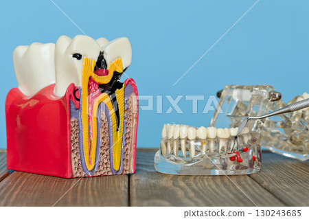 Tooth decay model and dental examination on jaw model Tooth decay model and dental examination on jaw model 130243685