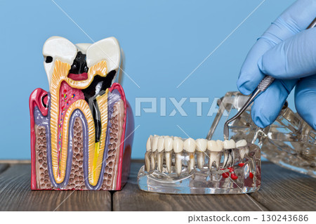 Dental decay model and jaw examination with explorer 130243686