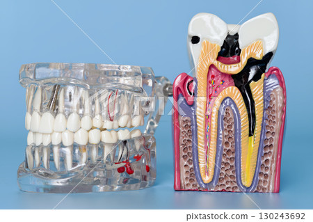 Dental jaw model and tooth decay anatomy model Dental jaw model and tooth decay anatomy model 130243692