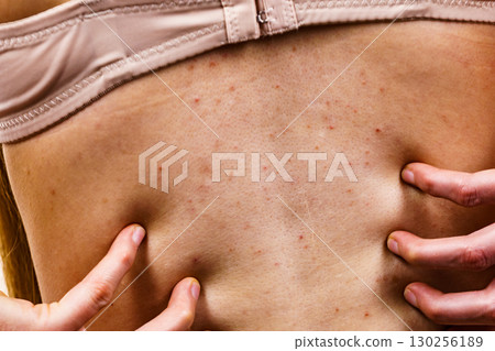 Woman with skin problem acne on back Woman with skin problem acne on back 130256189
