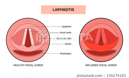 Laryngitis medical poster Laryngitis medical poster 130274183