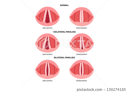 Vocal cords paralysis 130274185