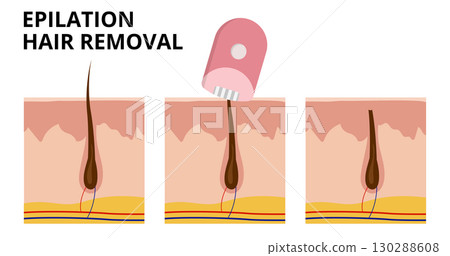 Electric epilator removing hair from underneath skin surface 130288608