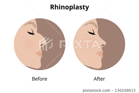 Woman profile showing rhinoplasty results, before and after 130288615