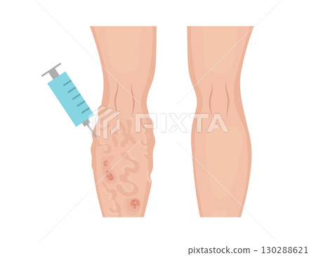 Sclerotherapy injecting medicine into varicose veins for treatment Sclerotherapy injecting medicine into varicose veins for treatment 130288621
