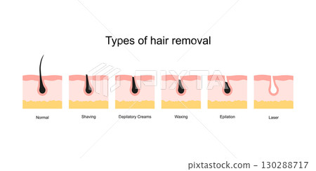 Different types of hair removal: shaving, waxing, depilatory cream, epilator, laser/IPL. Suitable for beauty, skincare, tutorial, comparison, or infographic use. Different types of hair removal: shaving, waxing, depilatory cream, epilator, laser/IPL. Suitable for beauty, skincare, tutorial, comparison, or infographic use. 130288717