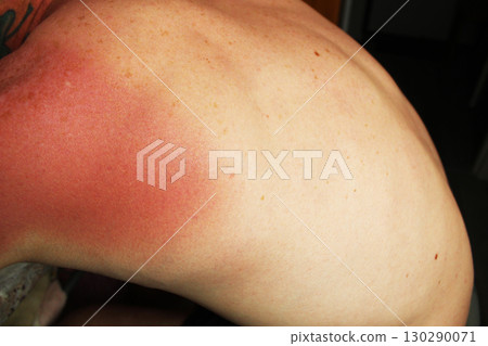 Red spots on the back of a male guy. Consequences of sun tanning 130290071