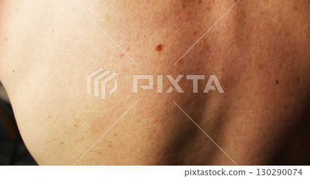 Back of a man with freckles and moles on the skin Back of a man with freckles and moles on the skin 130290074